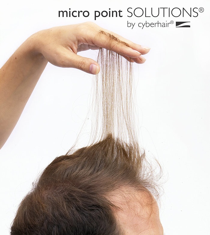 Micro Point Links & Fillers | World Hair Institute